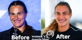 Aryna Sabalenka veneers, before and after